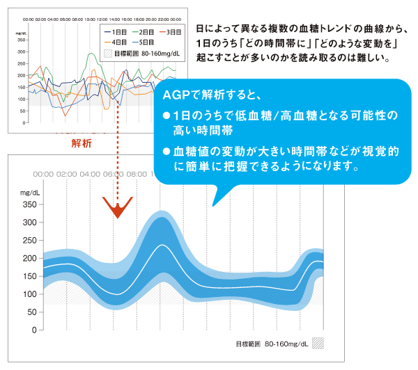 日によって異なる複数の血糖トレンドの曲線から、1日のうち「どの時間帯に」「どのような変動を」起こすことが多いのかを読み取るのは難しい。AGPで解析すると、1日のうちで低血糖／高血糖となる可能性の高い時間帯、血糖値の変動が大きい時間帯などが視覚的に簡単に把握できるようになります。